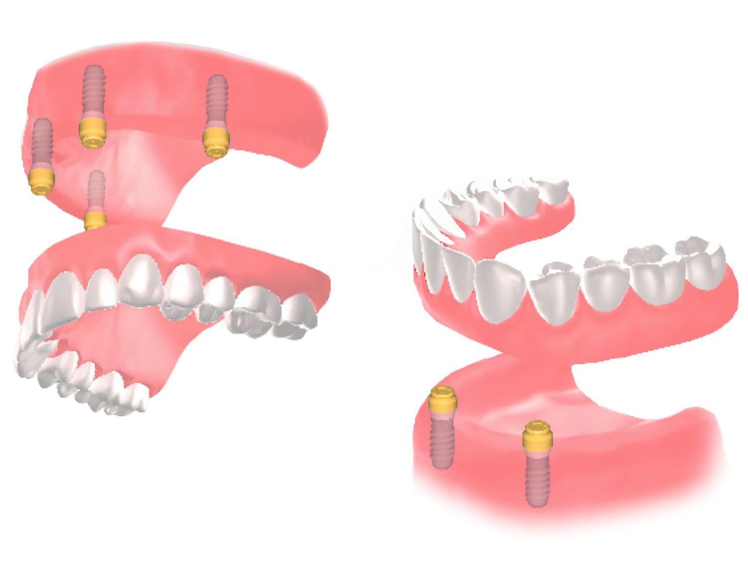 インプラントオーバーデンチャー | はやと歯科クリニック(北坂戸駅)北
